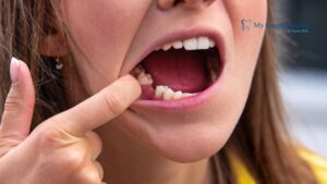 Tooth Loss