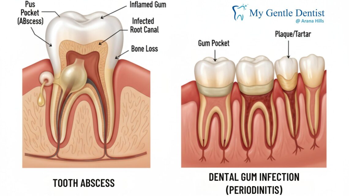 Tooth Abscess