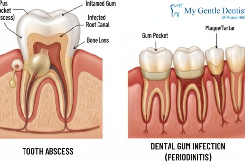 Tooth Abscess