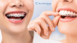 Invisalign vs Braces