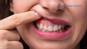 Swollen Gums