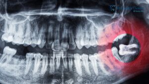 Wisdom Tooth Pain